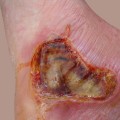 Understanding Third-Degree Burns: Causes, Complications, and Treatment