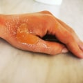 The Different Types of Burns and How to Treat Them