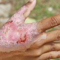 Understanding the Different Types of Burns