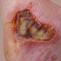 What causes a 1st degree burn?