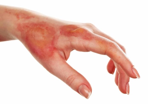 The Dangers of Leaving a Second-Degree Burn Untreated