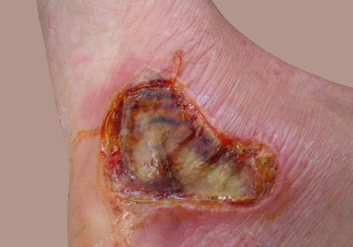 Understanding Third-Degree Burns: Causes, Complications, and Treatment