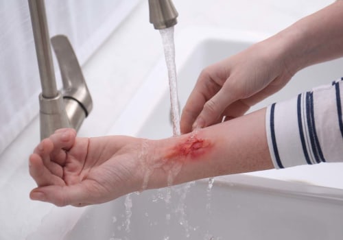 When to Seek Emergency Care for Burns