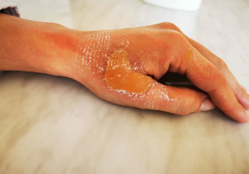 Understanding the Different Types of Burns