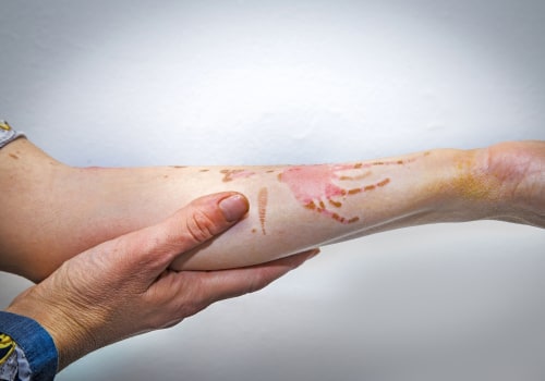 Understanding the Severity of Second-Degree Burns