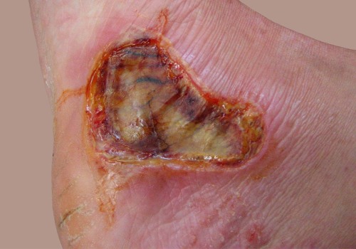 What causes a 1st degree burn?