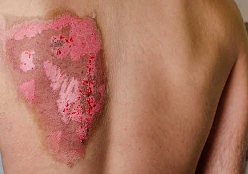 The Most Critical Issues with Third-Degree Burn Patients